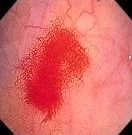 DUODENAL BLEEDING ANGIODYSPLASIA 