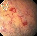 DUODENAL VASCULAR ECTASIA 