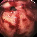 GASTRIC ANGIECTASIA