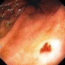 GASTRIC ANGIODYSPLASIA 