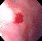 GASTRIC ANGIODYSPLASIA