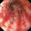 GASTRIC ANTRAL VASCULAR ECTASIA 
