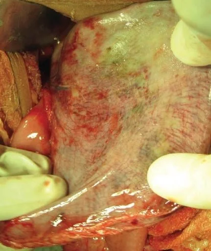 GASTRIC NECROSIS 