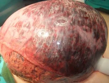 GASTRIC NECROSIS