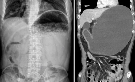 GASTRIC NECROSIS
