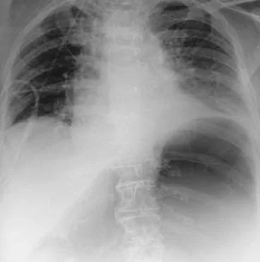 GASTRIC NECROSIS