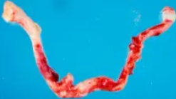 GIANT CELL ARTERITIS