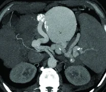 GIANT SPLENIC ARTERY ANEURYSM 