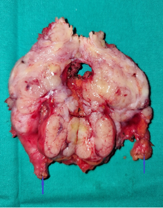PRIMARY LEIOMYOSARCOMA SAPHENOUS VEIN