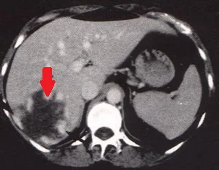 LIVER HAEMANGIOMA 