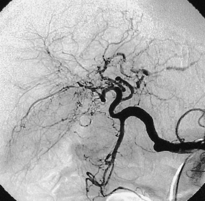 HEPATIC ARTERIES MICROANEURYSMS - POLYARTERITIS NODOSA