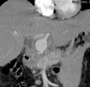 HEPATIC ARTERY ANEURYSM