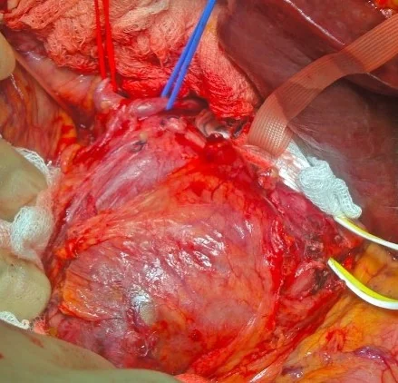 HEPATIC ARTERY ANEURYSM 