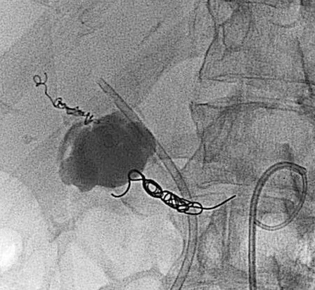 HEPATIC ARTERY ANEURYSM 