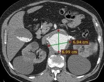 ABDOMINAL AORTA ANEURYSM