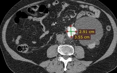 COMMON ILIAC ARTERY ANEURYSM