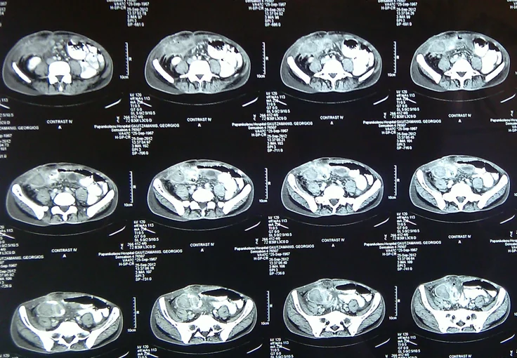 INFECTED HEMATOMA