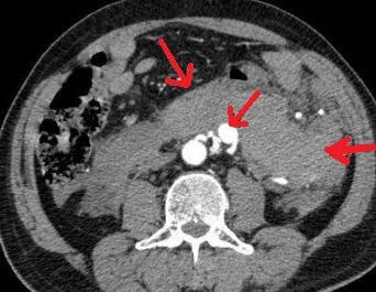 INFERIOR MESENTERIC ARTERY ANEURYSM