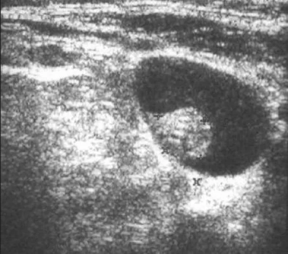 INTERNAL JUGULAR VEIN THROMBUS 