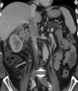 IVC TUMOR THROMBUS