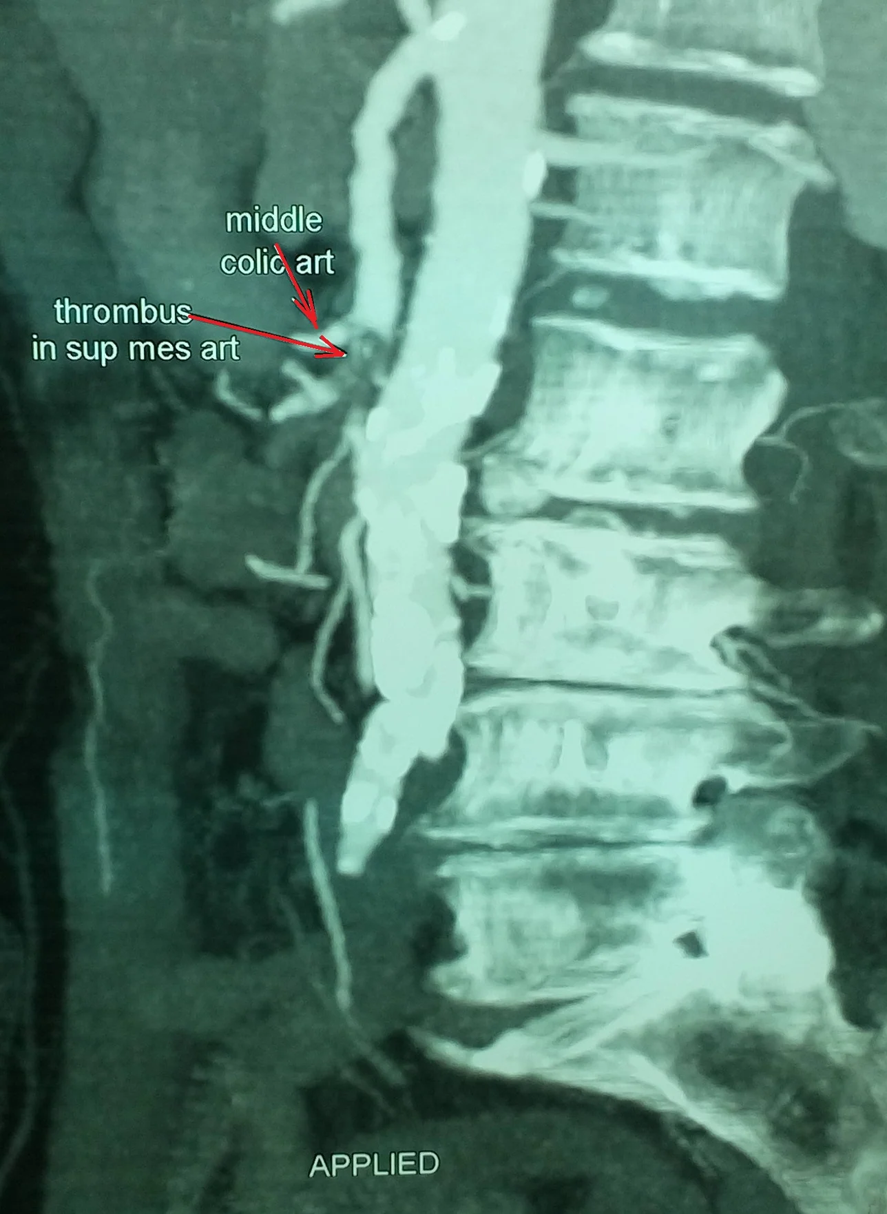 SMA THROMBOSIS