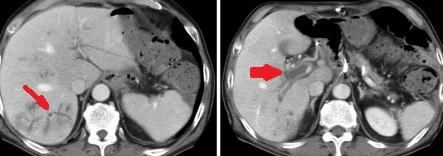 MASSIVE INTRAHEPATIC PORTAL VEIN THROMBUS