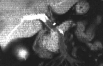 SUPERIOR MESENTERIC VEIN THROMBOSIS 
