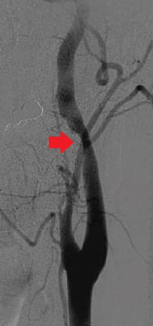 CAROTID ARTERY DISSECTION