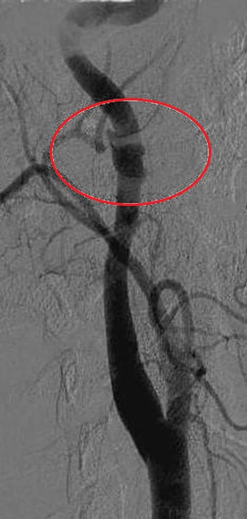 CAROTID ARTERY PSEUDOANEURYSM