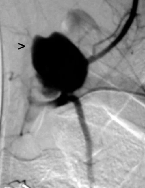 LEFT SUBCLAVIAN ARTERY RUPTURE