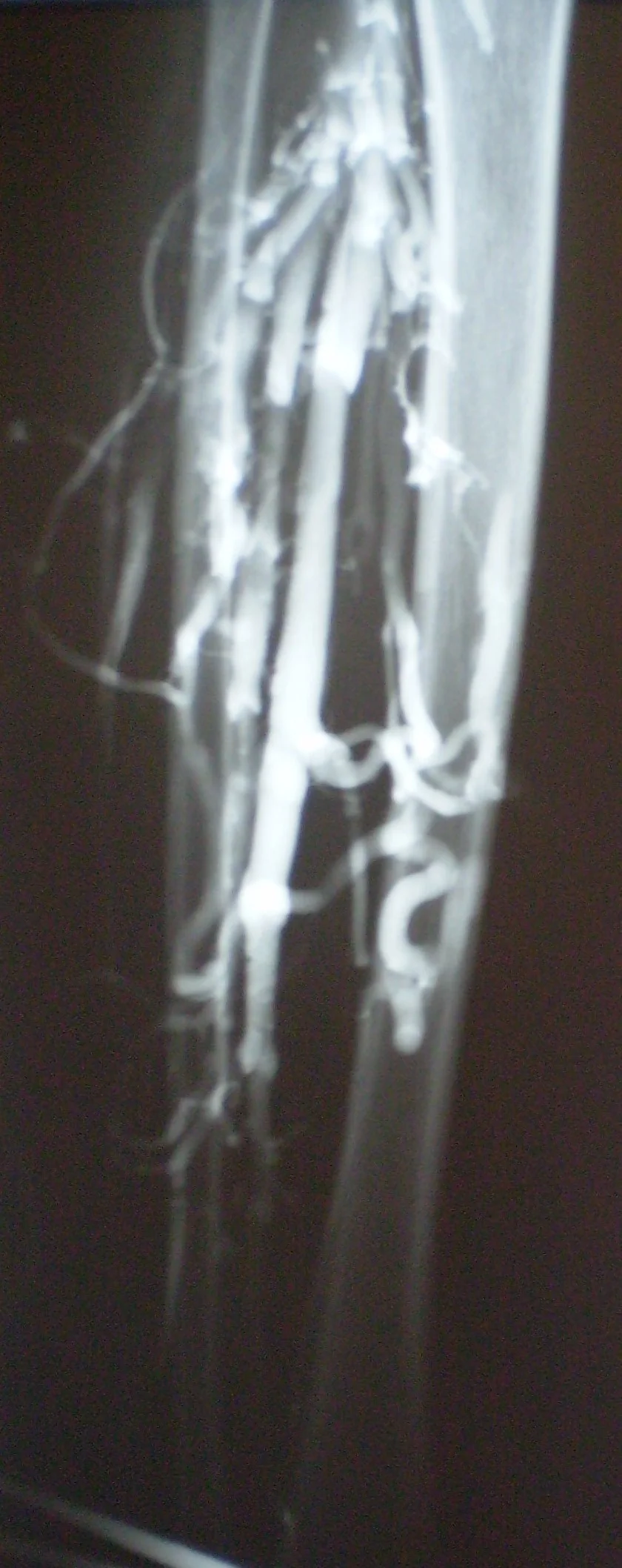 LOWER LIMP PHLEBOGRAPHY