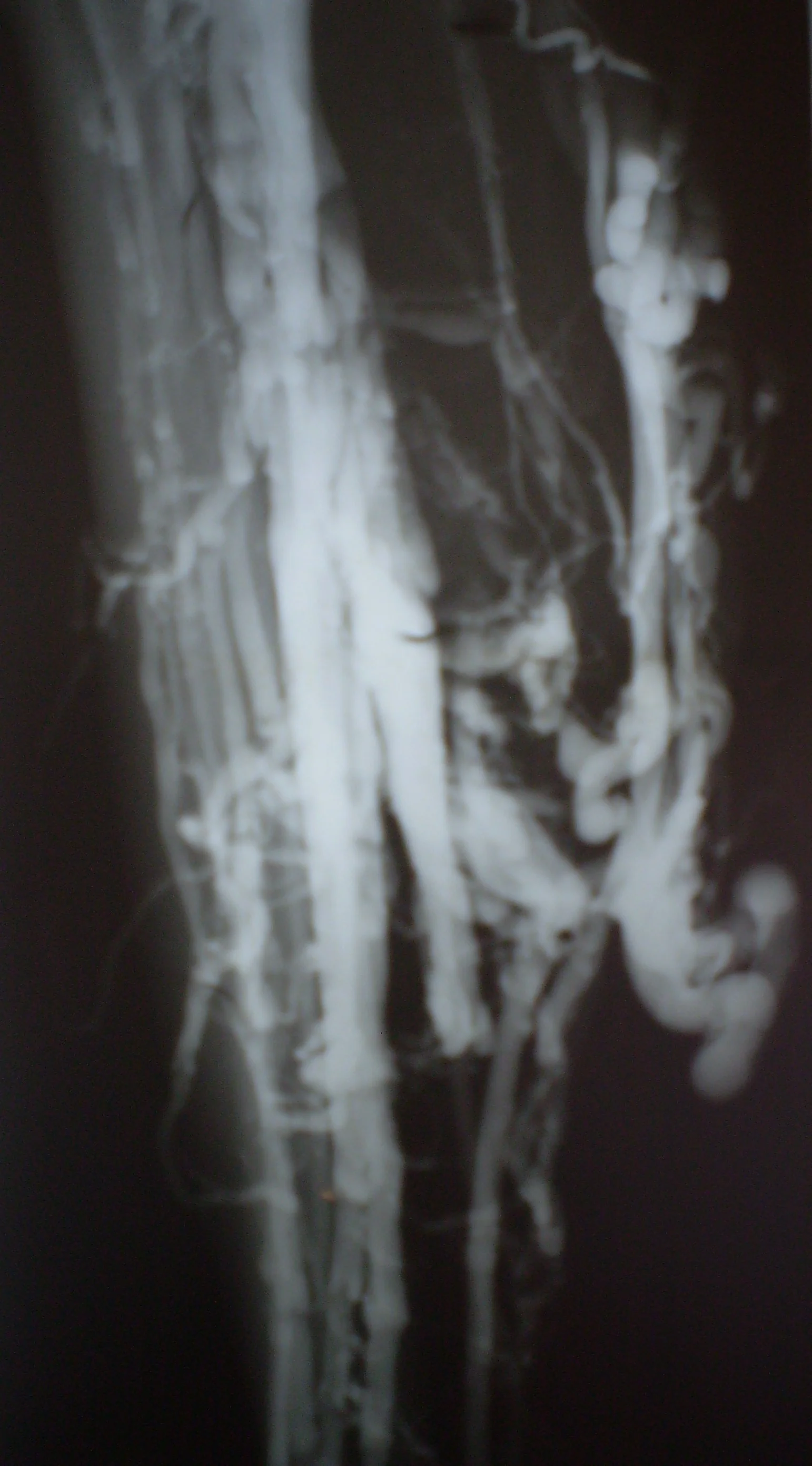 LOWER LIMP PHLEBOGRAPHY