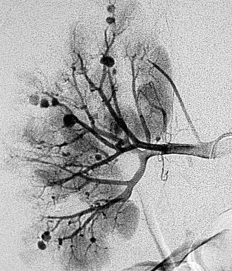 POLYARTERITIS NODOSA - KIDNEY