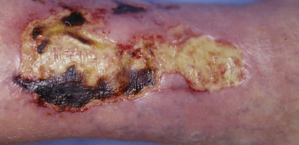 POLYARTERITIS NODOSA