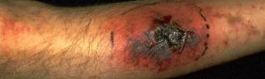 POLYARTERITIS NODOSA