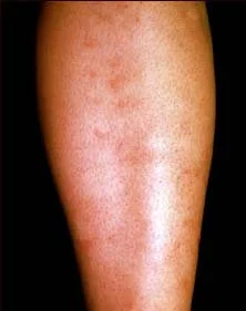 POLYARTERITIS NODOSA