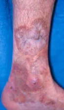 POLYARTERITIS NODOSA