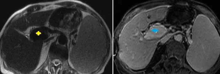 PORTAL VEIN ANEURYSM 