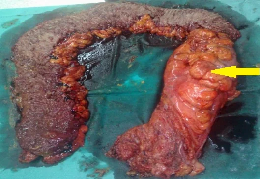 PORTAL VEIN THROMBOSIS - COLECTOMY 