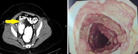 PORTAL VEIN THROMBOSIS - COLECTOMY