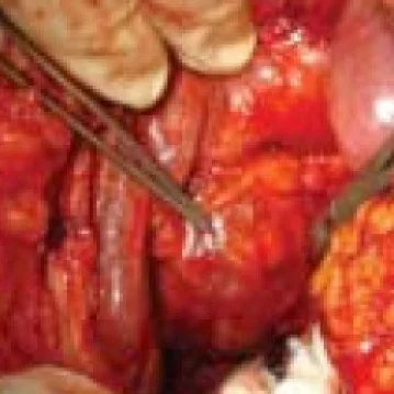 POSTCOLECYSTECTOMY PSEUDOANEURYSM