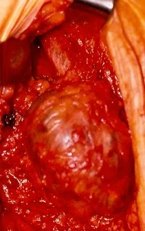 FEMORAL ARTERY PSEUDOANEURYSM