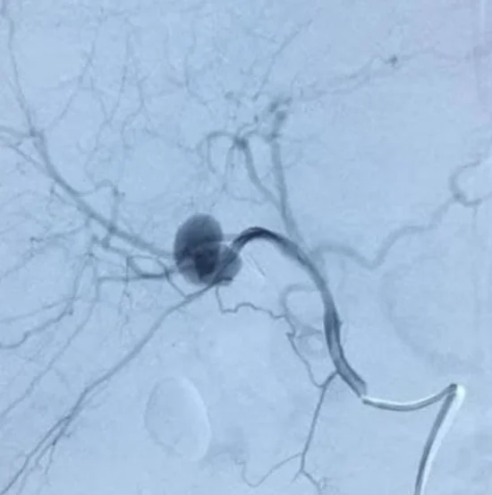 RIGHT HEPATIC ARTERY ANEURYSM