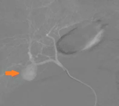 RIGHT HEPATIC ARTERY PSEUDOANEURYSM