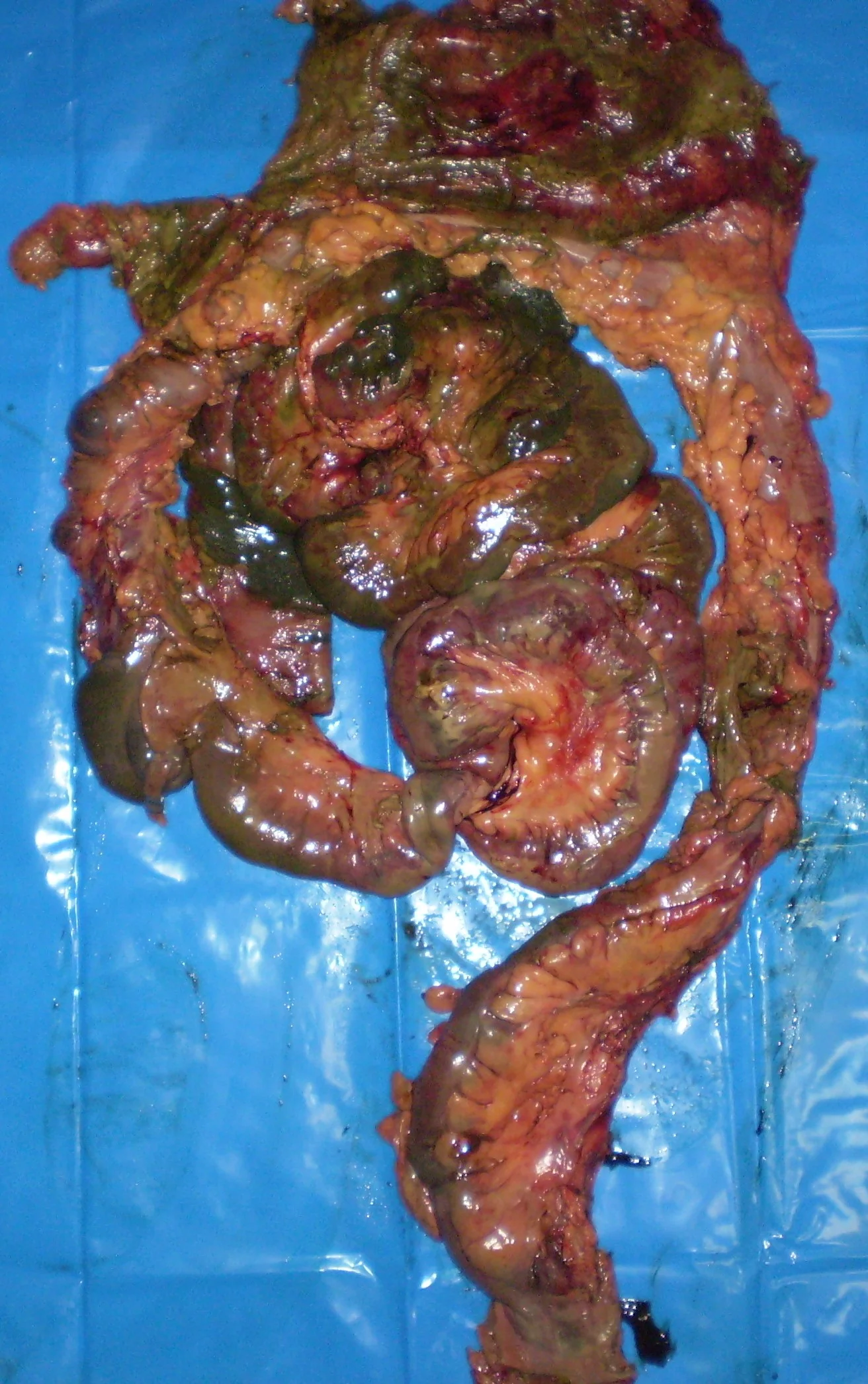 SUPERIOR + INFERIOR MESENTERIC ARTERIES THROMBOSIS