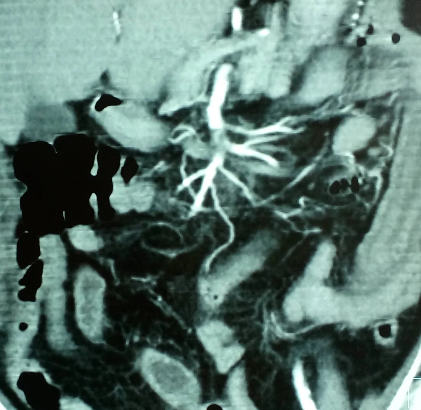 SUPERIOR MESENTERIC ARTERY THROMBOSIS
