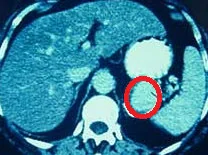 SPLENIC ARTERY ANEURYSM 