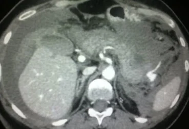 SPLENIC ARTERY ANEURYSM RUPTURE 