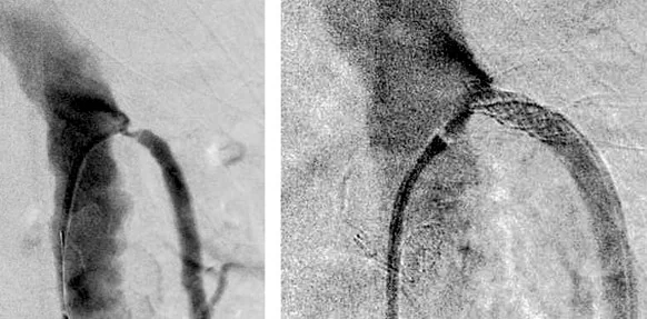 STENTING SUPERIOR MESENTERIC ARTERY