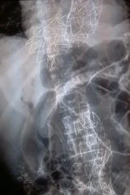 STENTΙΝG THORACIC + ABDOMINAL AORTA